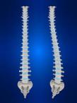 Scoliosis Osteopenia Osteoporosis ; Cause and treatments