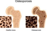 Fosamax medication . Osteoporosis drug. How long should you take this drug?