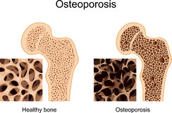 Osteomalacia Or Osteoporosis Definitions Causes Treatment